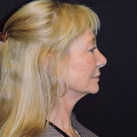 Facelift before and after, case 3459 - Cool Springs Plastic Surgery