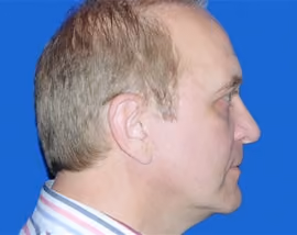 Facelift before and after, case 3483 - Cool Springs Plastic Surgery