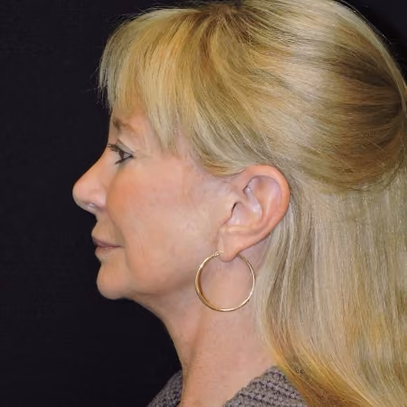 Facelift before and after, case 3459 - Cool Springs Plastic Surgery