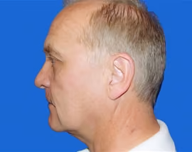 Facelift before and after, case 3483 - Cool Springs Plastic Surgery
