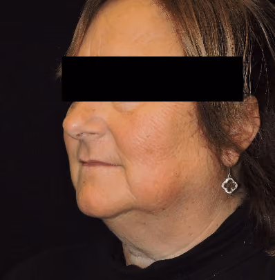 Facelift before and after, case 3531 - Cool Springs Plastic Surgery