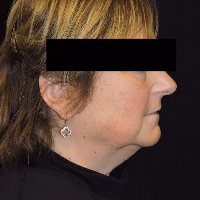 Facelift before and after, case 3531 - Cool Springs Plastic Surgery