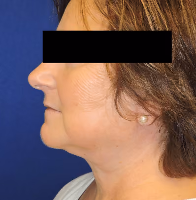 Facelift before and after, case 3531 - Cool Springs Plastic Surgery