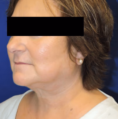 Facelift before and after, case 3531 - Cool Springs Plastic Surgery