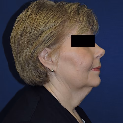 Facelift before and after, case 3538 - Cool Springs Plastic Surgery
