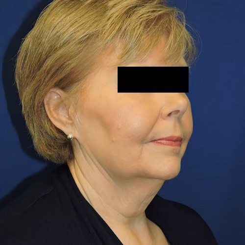 Facelift before and after, case 3538 - Cool Springs Plastic Surgery
