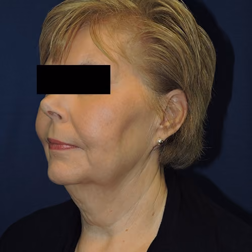 Facelift before and after, case 3538 - Cool Springs Plastic Surgery