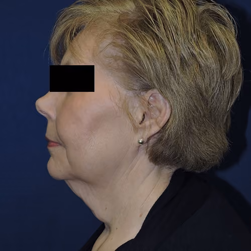 Facelift before and after, case 3538 - Cool Springs Plastic Surgery