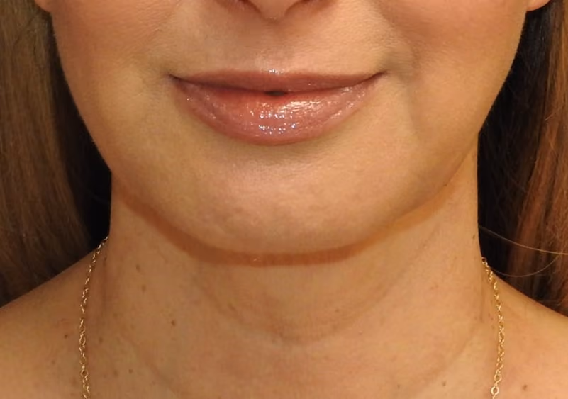 Facelift before and after, case 3557 - Cool Springs Plastic Surgery
