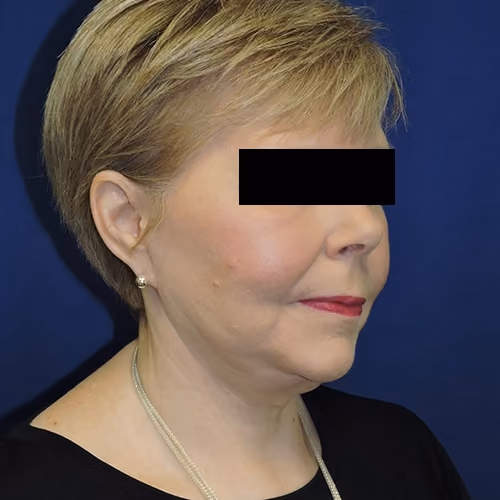 Facelift before and after, case 3538 - Cool Springs Plastic Surgery