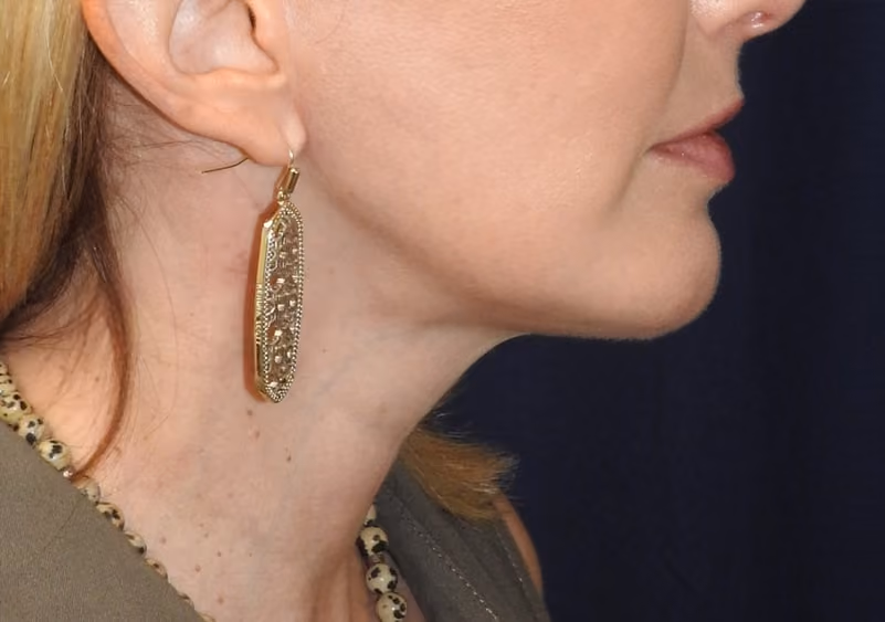 Facelift before and after, case 3557 - Cool Springs Plastic Surgery