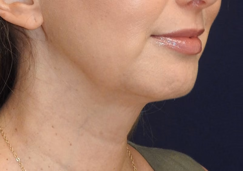 Facelift before and after, case 3557 - Cool Springs Plastic Surgery