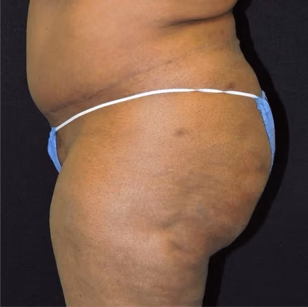 Brazilian Butt Lift before and after, case 6929 - Cool Springs Plastic Surgery