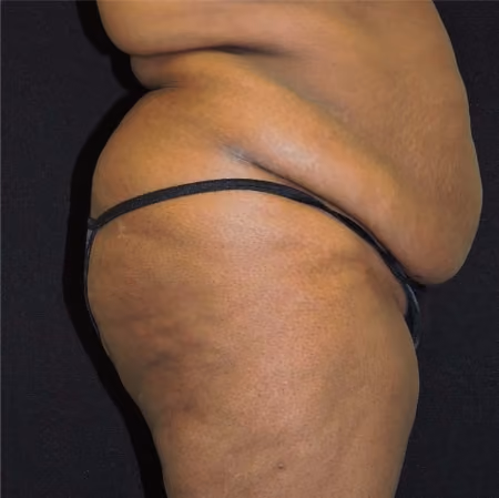 Brazilian Butt Lift before and after, case 6929 - Cool Springs Plastic Surgery