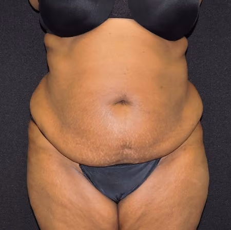 Brazilian Butt Lift before and after, case 6929 - Cool Springs Plastic Surgery