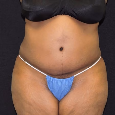 Brazilian Butt Lift before and after, case 6929 - Cool Springs Plastic Surgery