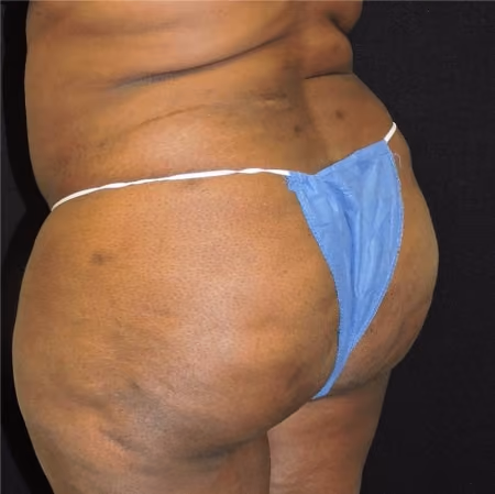 Brazilian Butt Lift before and after, case 6929 - Cool Springs Plastic Surgery