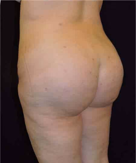 Brazilian Butt Lift before and after, case 7177 - Cool Springs Plastic Surgery