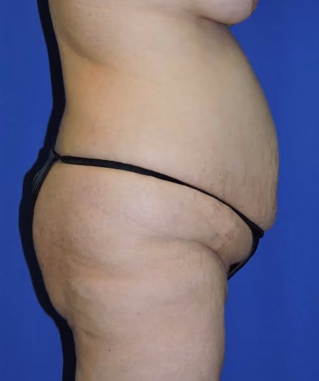 Brazilian Butt Lift before and after, case 7177 - Cool Springs Plastic Surgery