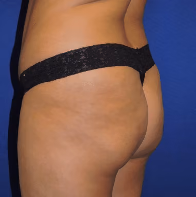 Brazilian Butt Lift before and after, case 7386 - Cool Springs Plastic Surgery