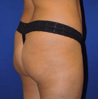 Brazilian Butt Lift before and after, case 7386 - Cool Springs Plastic Surgery