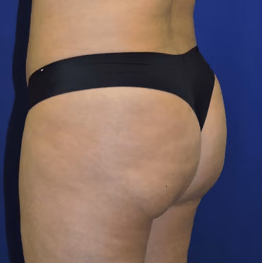 Brazilian Butt Lift before and after, case 7386 - Cool Springs Plastic Surgery