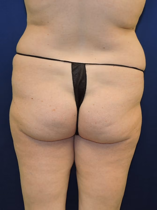 Brazilian Butt Lift before and after, case 7747 - Cool Springs Plastic Surgery