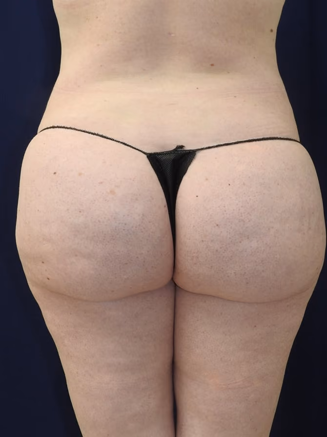 Brazilian Butt Lift before and after, case 7747 - Cool Springs Plastic Surgery