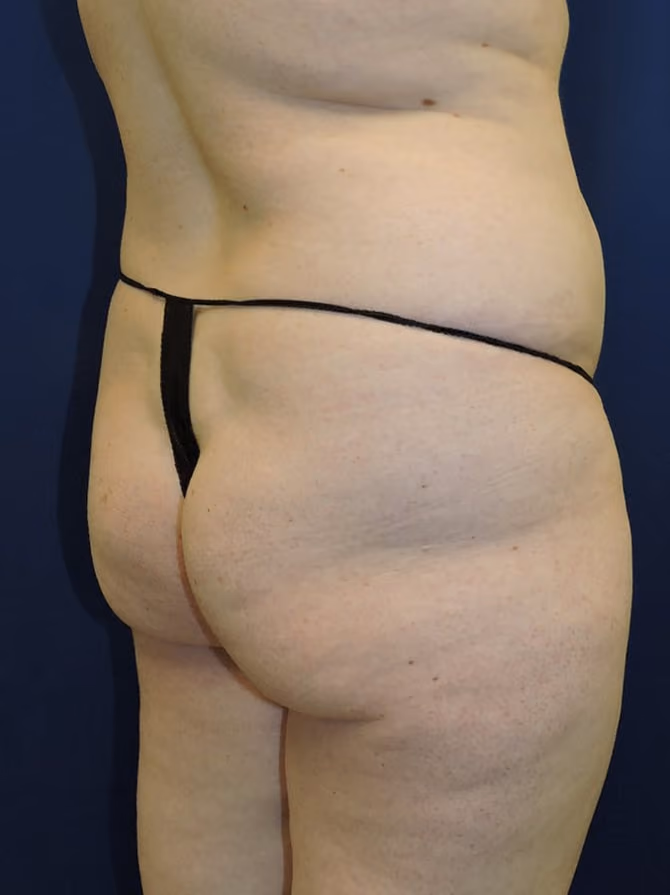 Brazilian Butt Lift before and after, case 7747 - Cool Springs Plastic Surgery