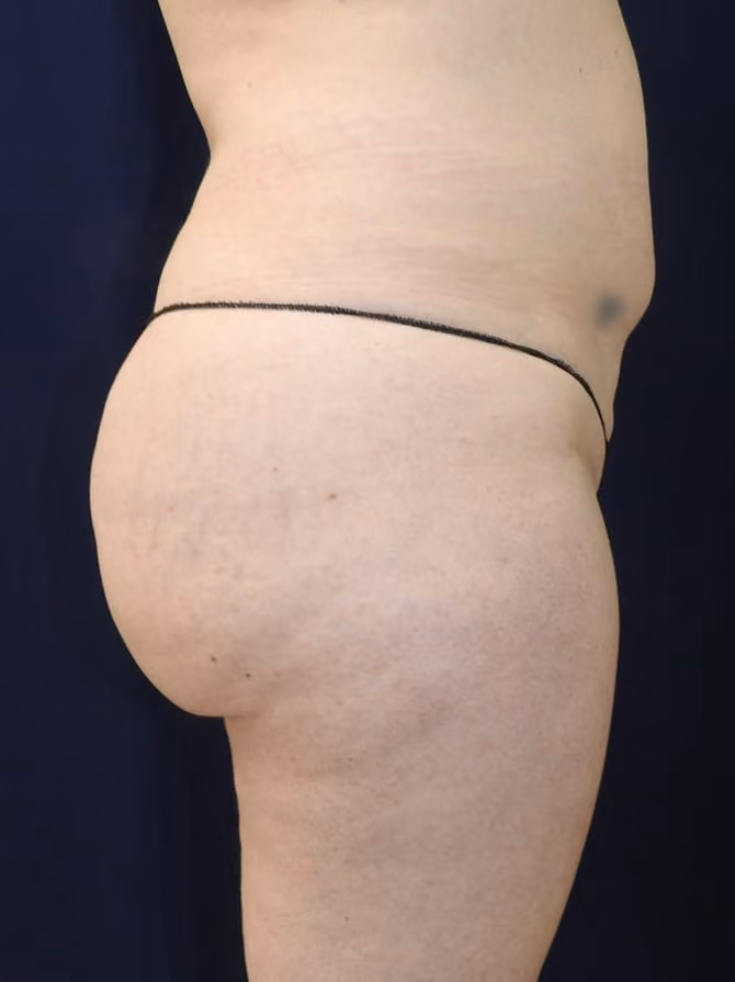 Brazilian Butt Lift before and after, case 7747 - Cool Springs Plastic Surgery