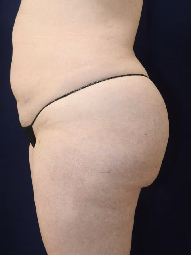 Brazilian Butt Lift before and after, case 7747 - Cool Springs Plastic Surgery