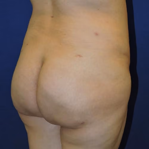 Brazilian Butt Lift before and after, case 7937 - Cool Springs Plastic Surgery
