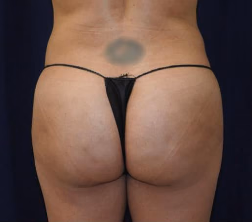 Brazilian Butt Lift before and after, case 7824 - Cool Springs Plastic Surgery