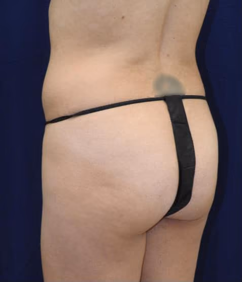 Brazilian Butt Lift before and after, case 7824 - Cool Springs Plastic Surgery