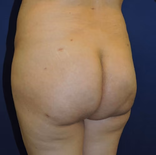 Brazilian Butt Lift before and after, case 7937 - Cool Springs Plastic Surgery