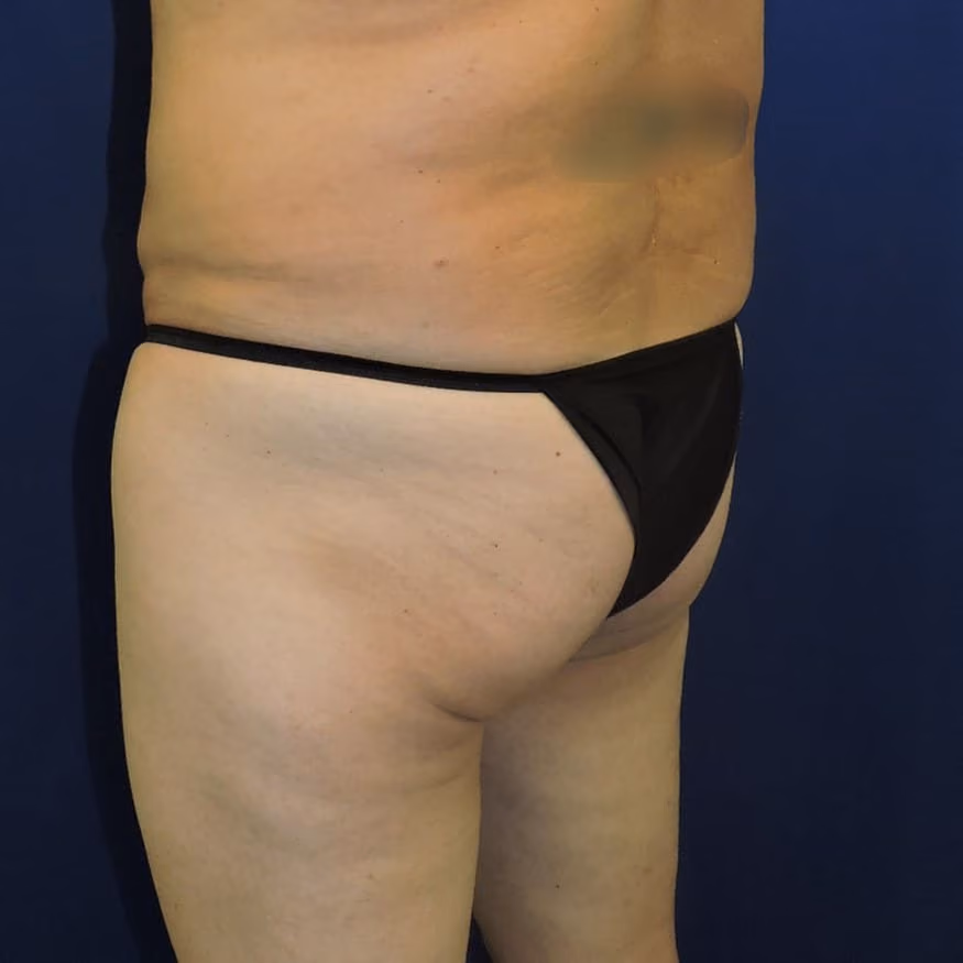Brazilian Butt Lift before and after, case 8007 - Cool Springs Plastic Surgery