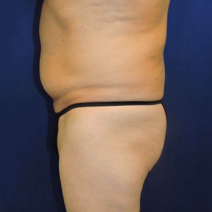 Brazilian Butt Lift before and after, case 8007 - Cool Springs Plastic Surgery