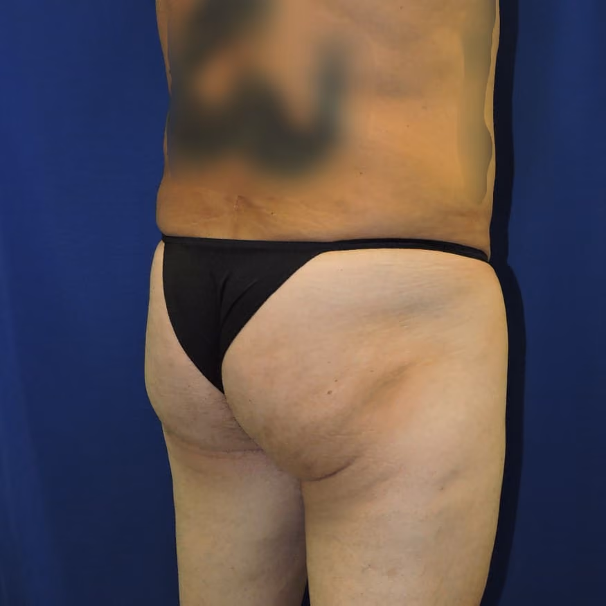 Brazilian Butt Lift before and after, case 8007 - Cool Springs Plastic Surgery