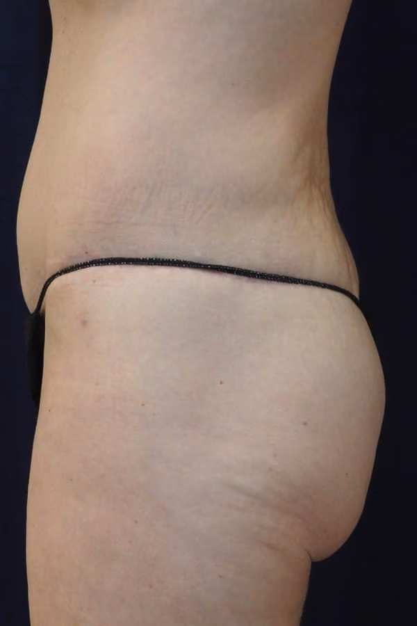Brazilian Butt Lift before and after, case 8234 - Cool Springs Plastic Surgery