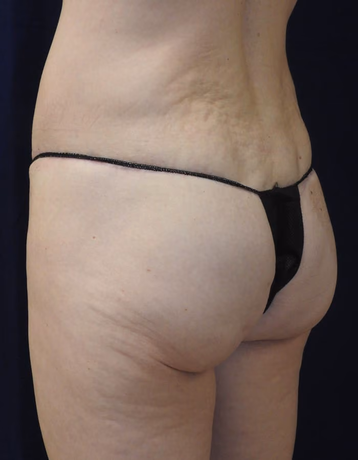 Brazilian Butt Lift before and after, case 8234 - Cool Springs Plastic Surgery