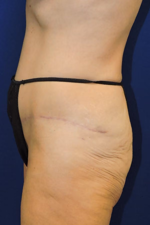 Brazilian Butt Lift before and after, case 8234 - Cool Springs Plastic Surgery