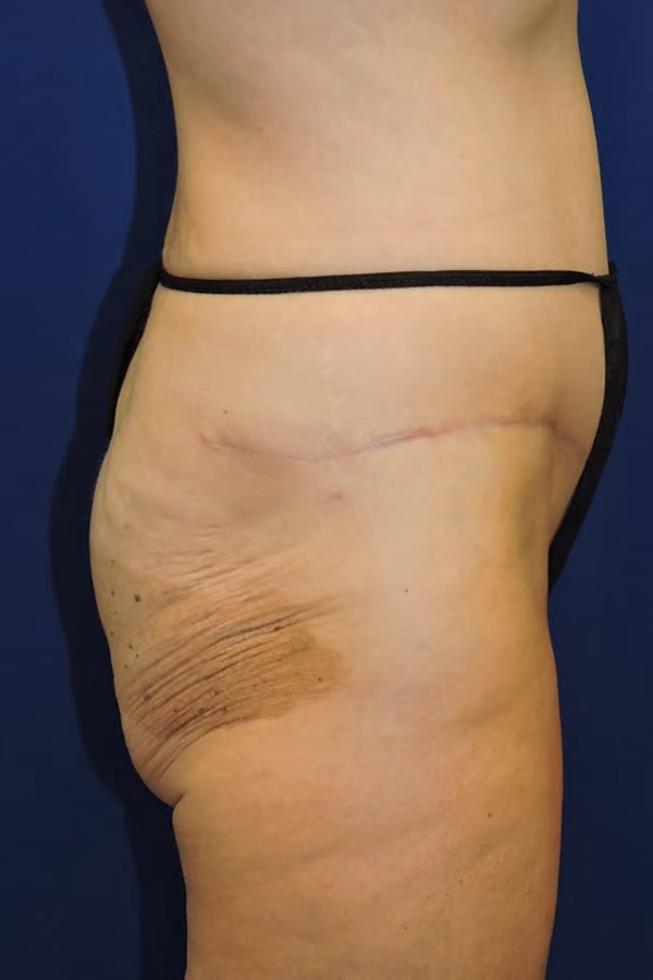 Brazilian Butt Lift before and after, case 8234 - Cool Springs Plastic Surgery