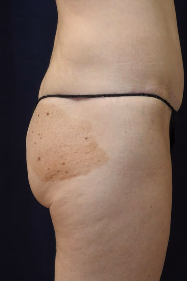 Brazilian Butt Lift before and after, case 8234 - Cool Springs Plastic Surgery