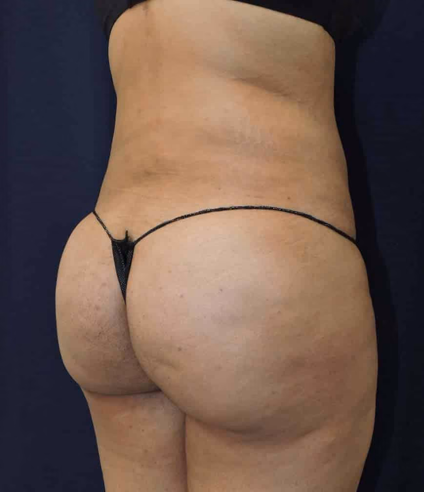 Brazilian Butt Lift before and after, case 8371 - Cool Springs Plastic Surgery