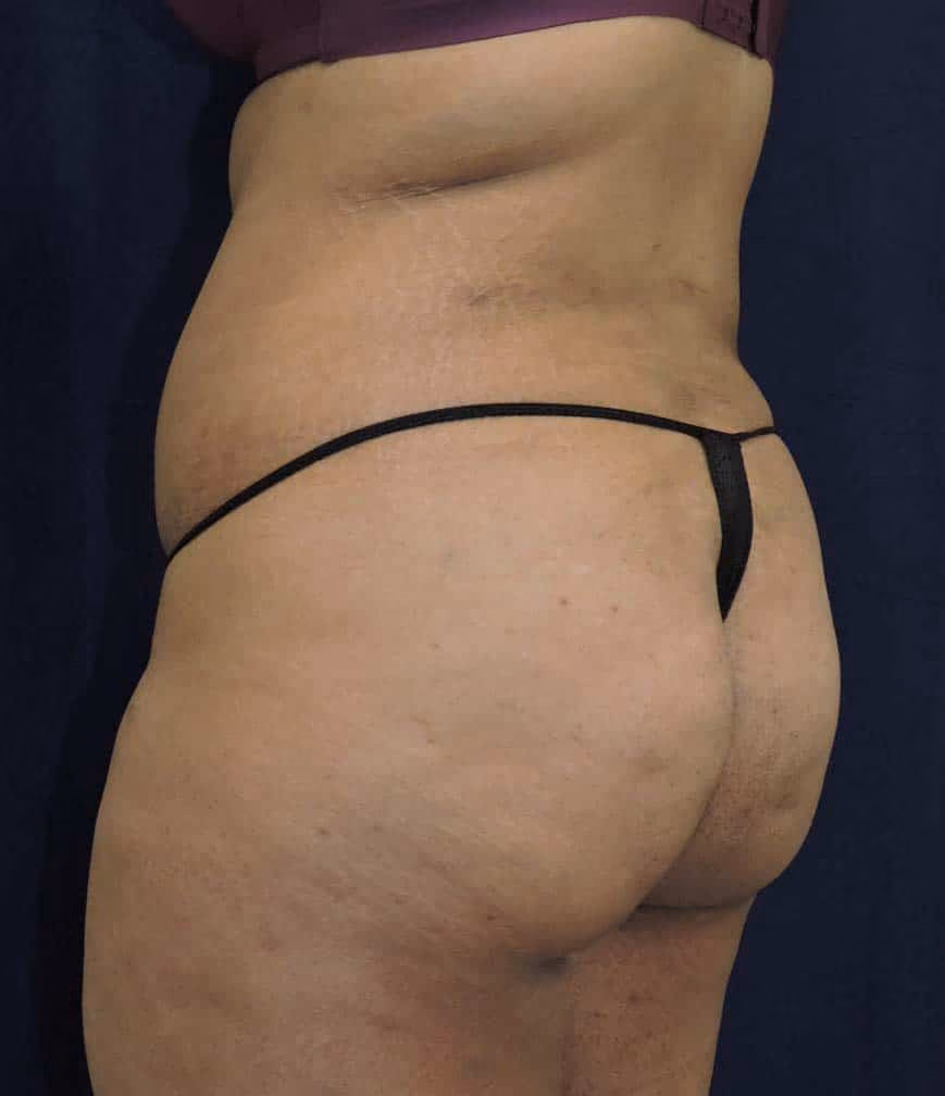 Brazilian Butt Lift before and after, case 8371 - Cool Springs Plastic Surgery