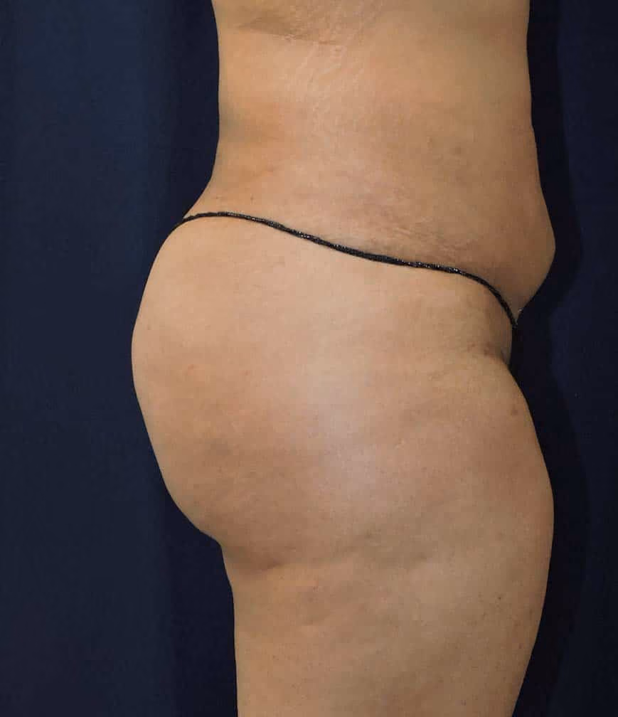 Brazilian Butt Lift before and after, case 8371 - Cool Springs Plastic Surgery