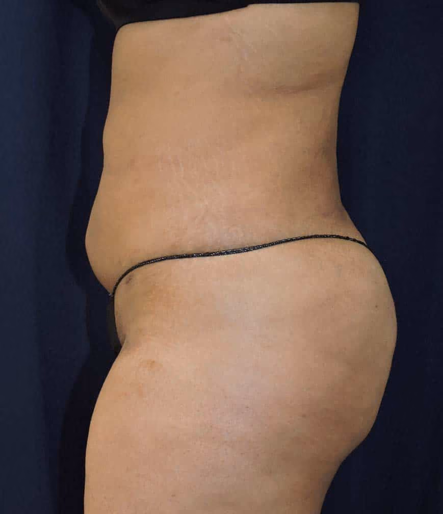 Brazilian Butt Lift before and after, case 8371 - Cool Springs Plastic Surgery