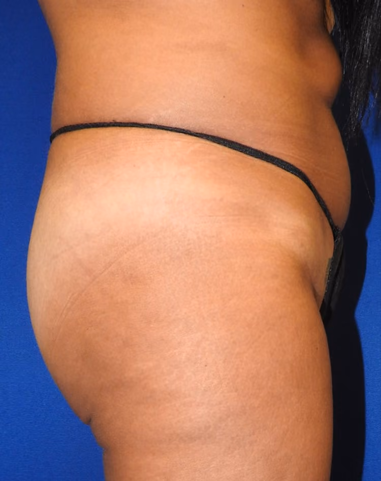 Brazilian Butt Lift before and after, case 8435 - Cool Springs Plastic Surgery