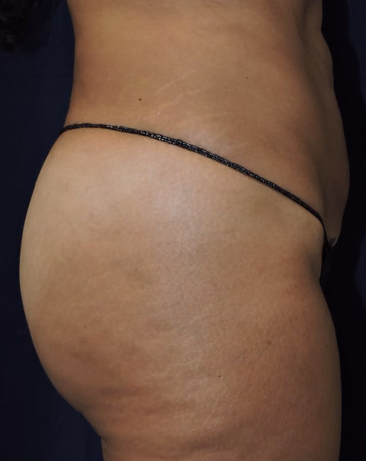 Brazilian Butt Lift before and after, case 8435 - Cool Springs Plastic Surgery