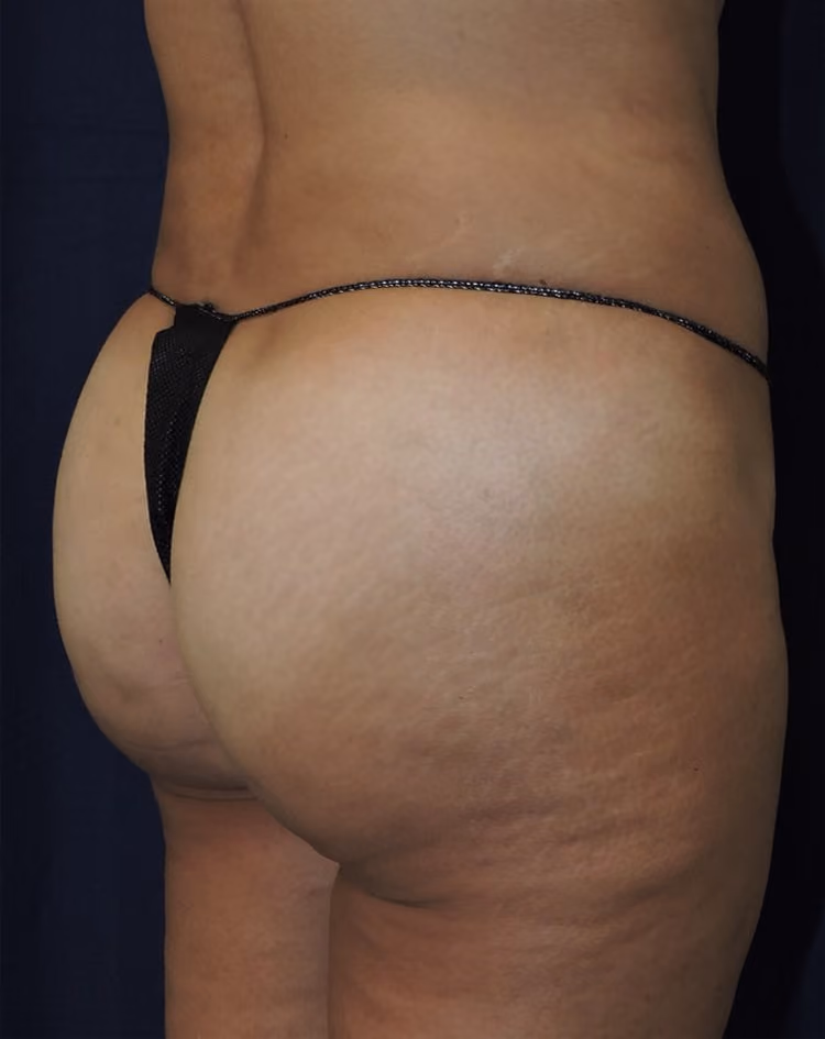 Brazilian Butt Lift before and after, case 8435 - Cool Springs Plastic Surgery